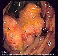 Cancerul intestinal